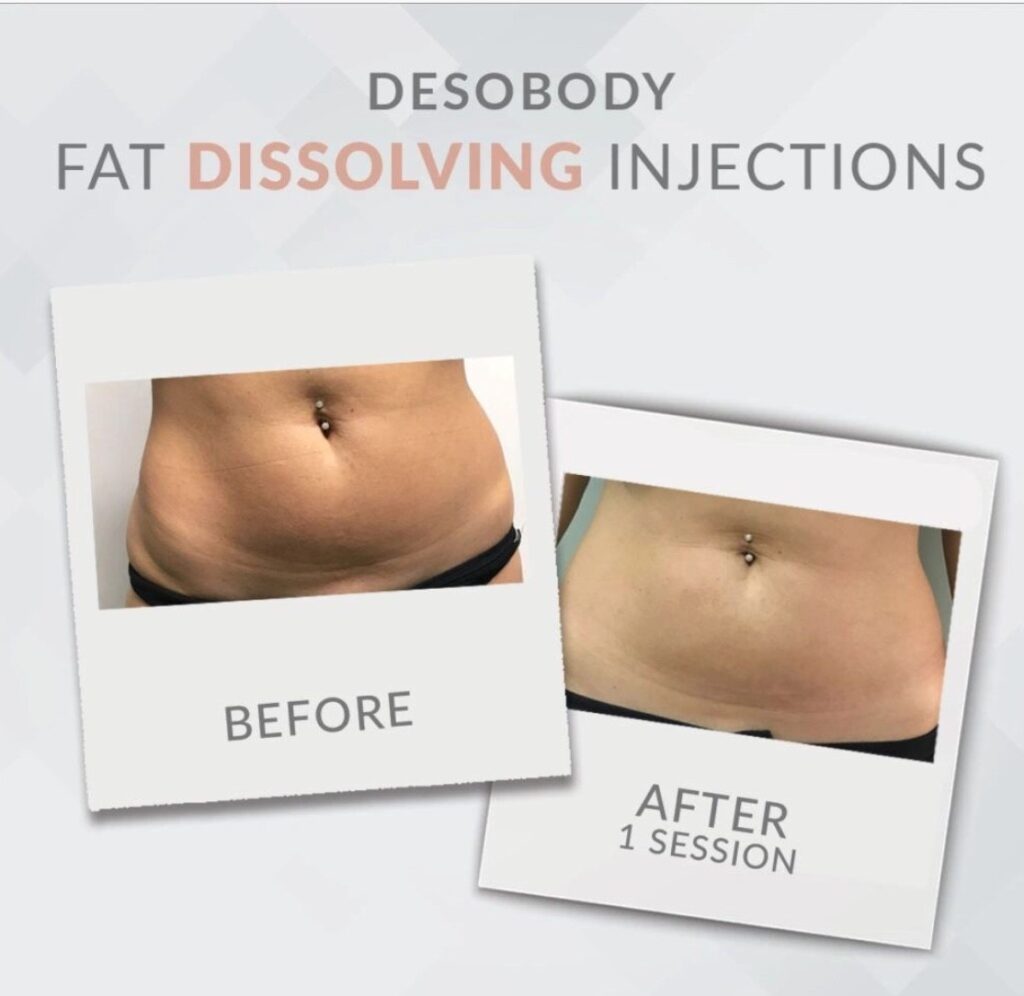 fat-dissolving-injections