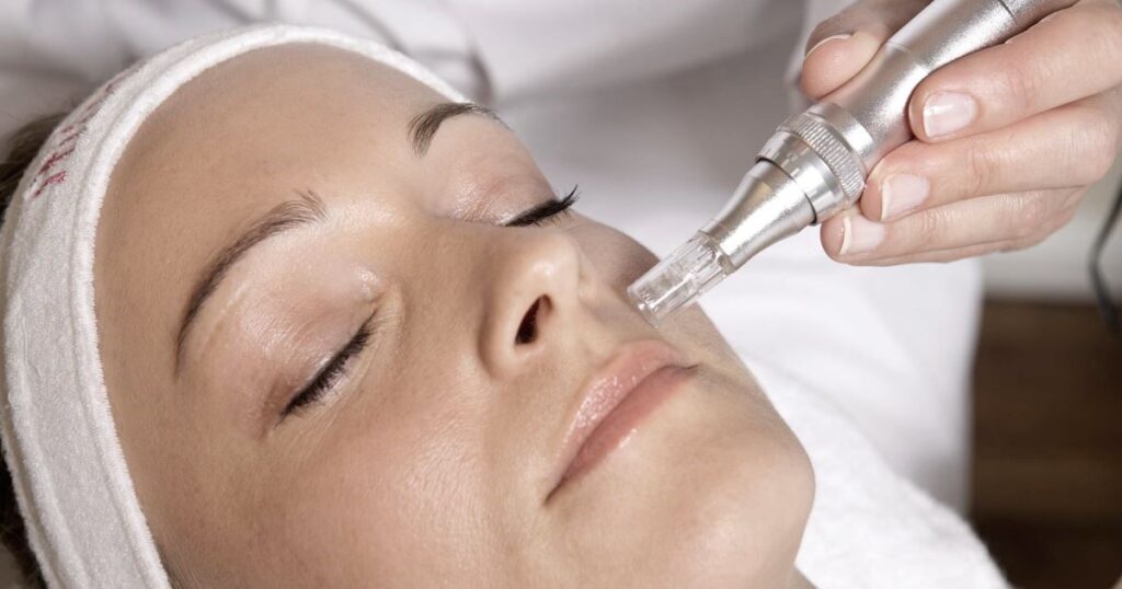 microneedling therapy